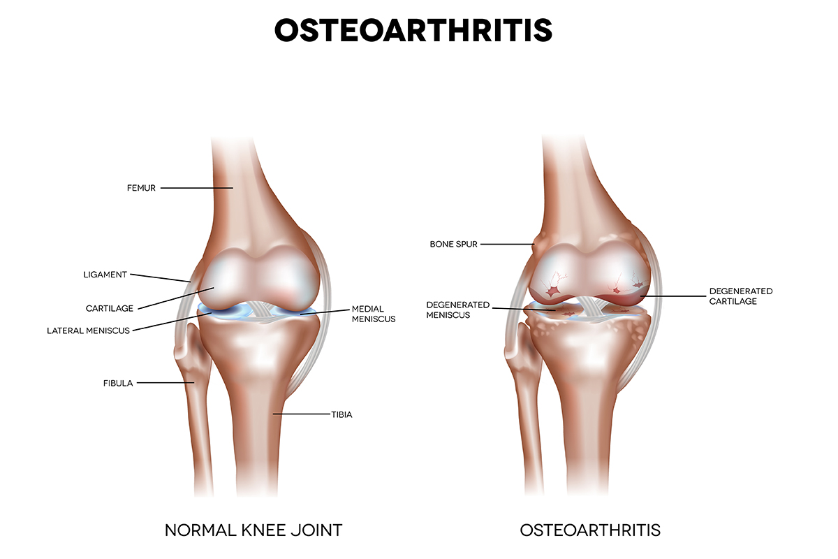 What is Osteoarthritis?: Causes, Symptoms, Remedies