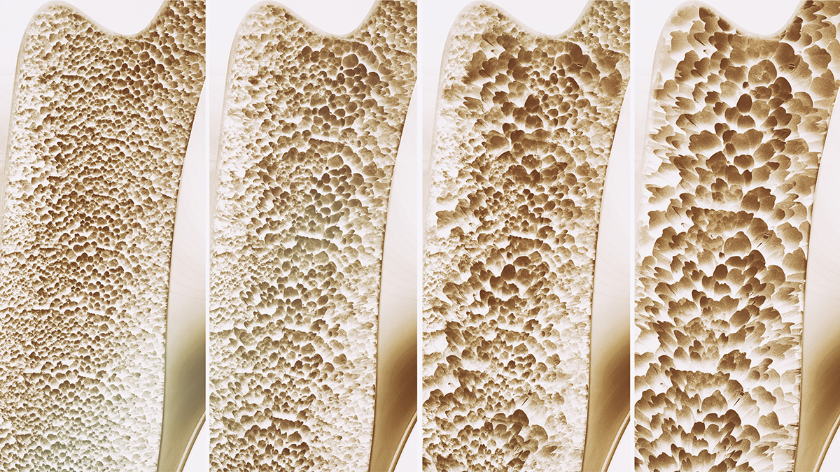 What is Osteoporosis? Causes, Symptoms, Preventive Measures